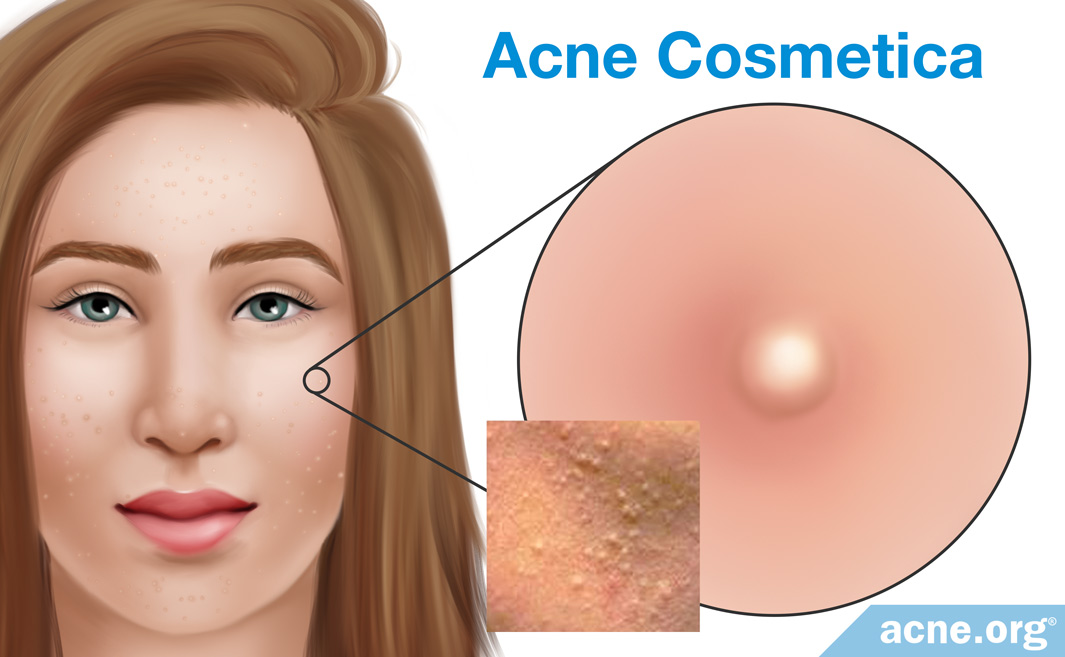 Can Makeup Cause Acne? 