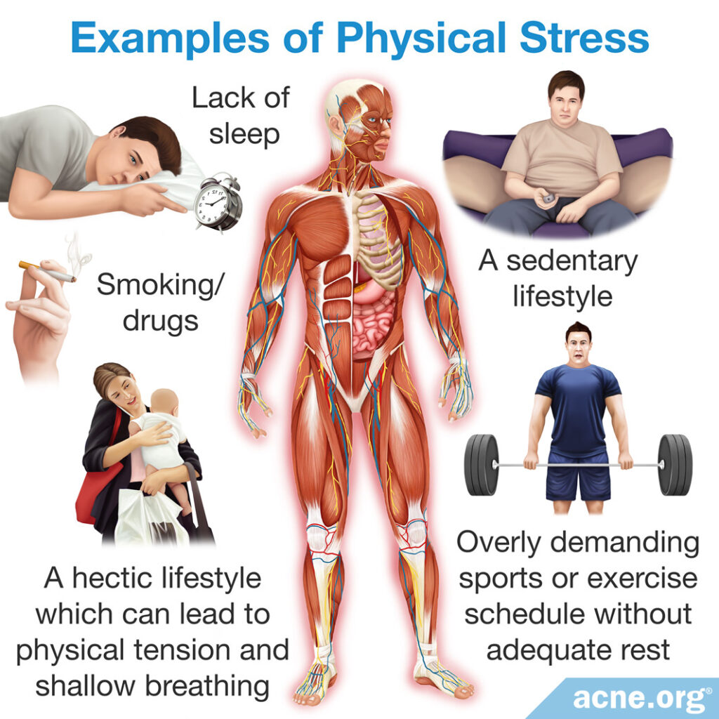 Examples of Physical Stress