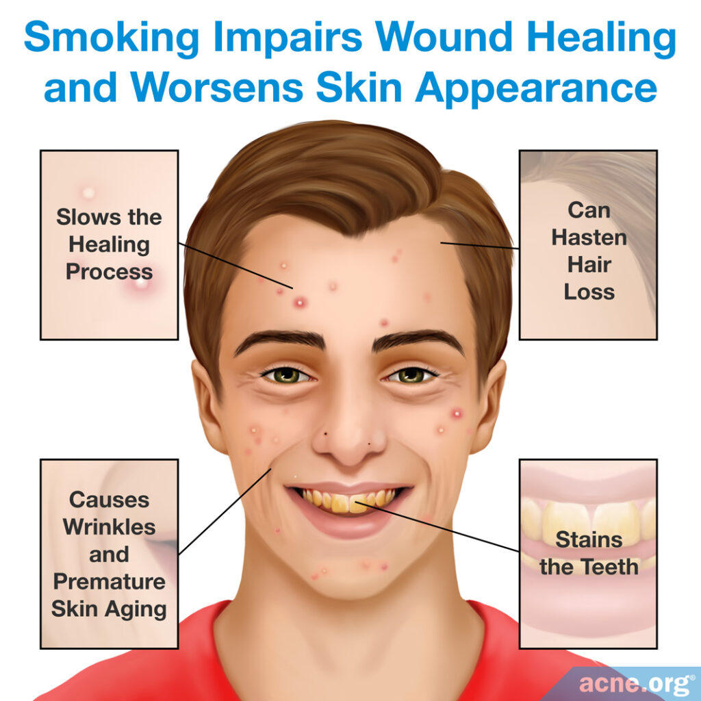 Smoking Impairs Wound Healing and Worsens Skin Appearance