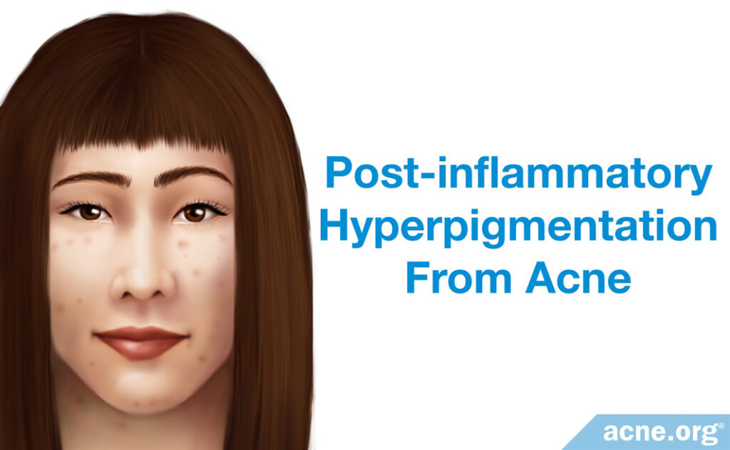 Post-inflammatory Hyperpigmentation from Acne