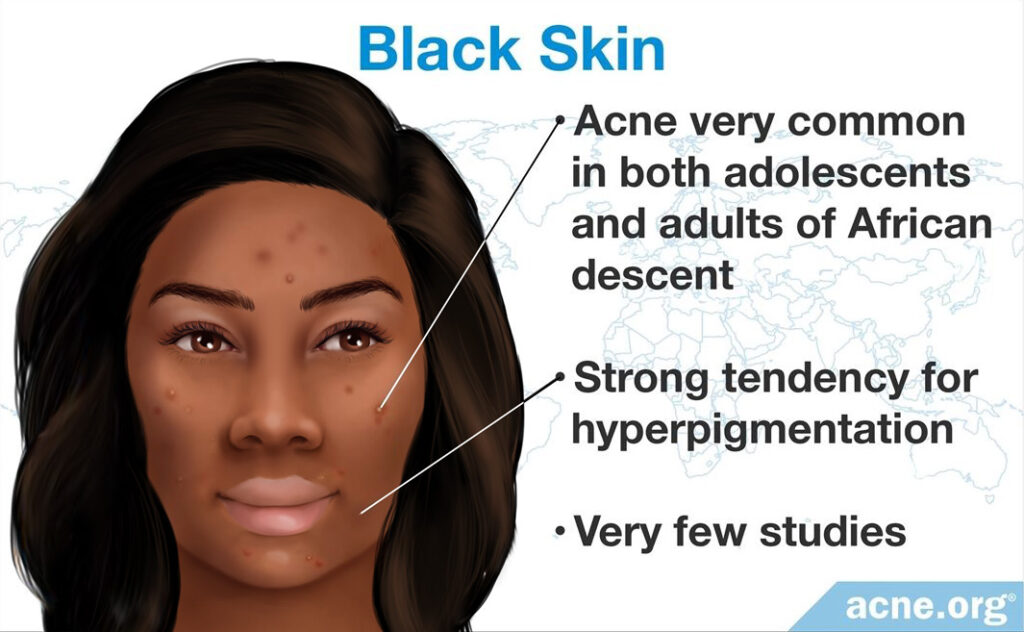 Black Skin and Acne