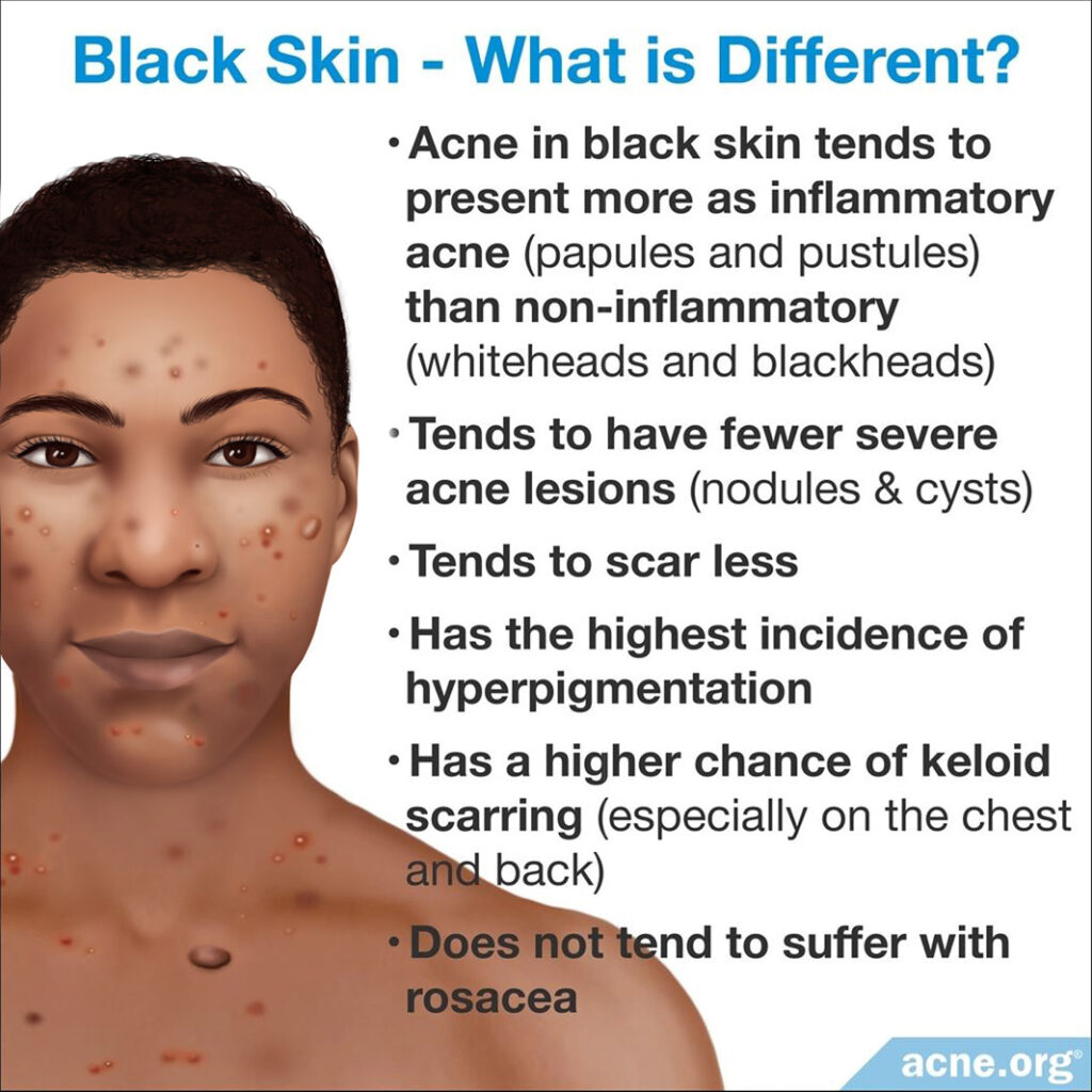 What Is Different about Black Skin?