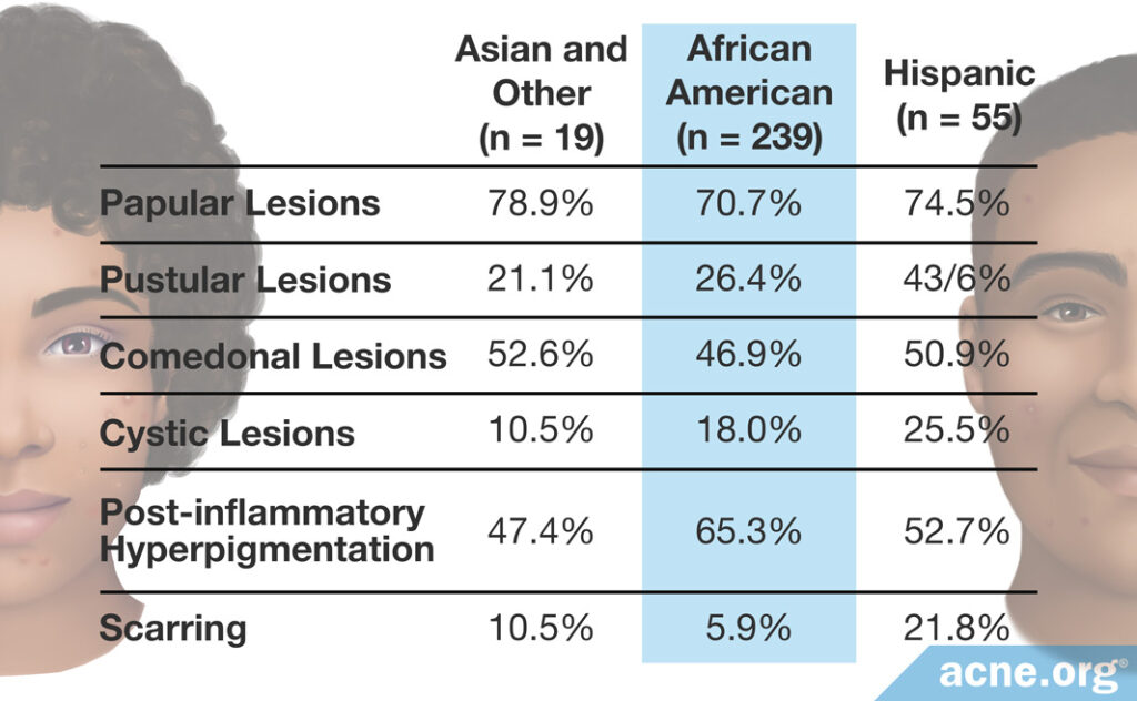 Types of Acne by Ethnicity