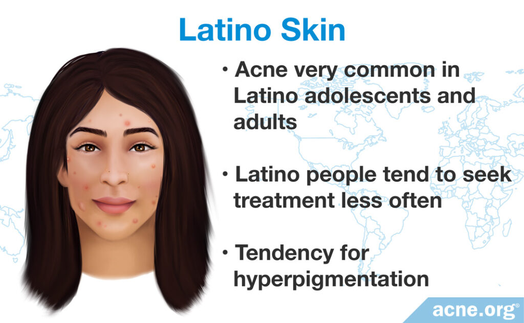 Latino Skin and Acne