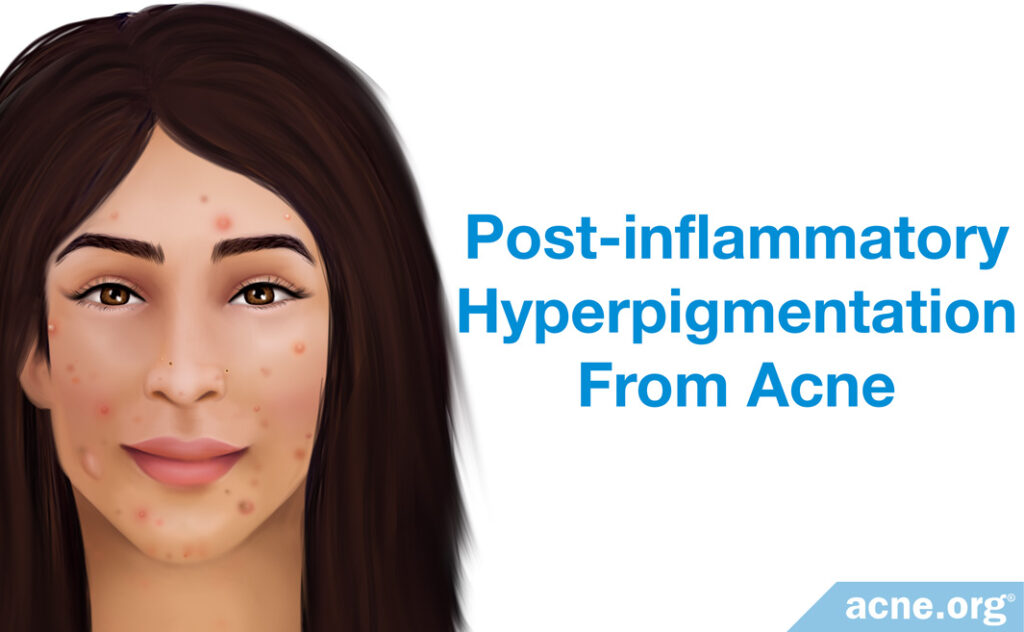 Post-inflammatory Hyperpigmentation from Acne