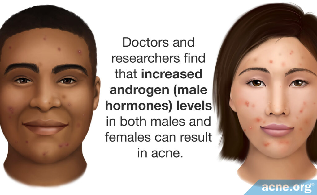 Doctors and researchers find that increased androgen (male hormones) levels in both males and females can result in acne