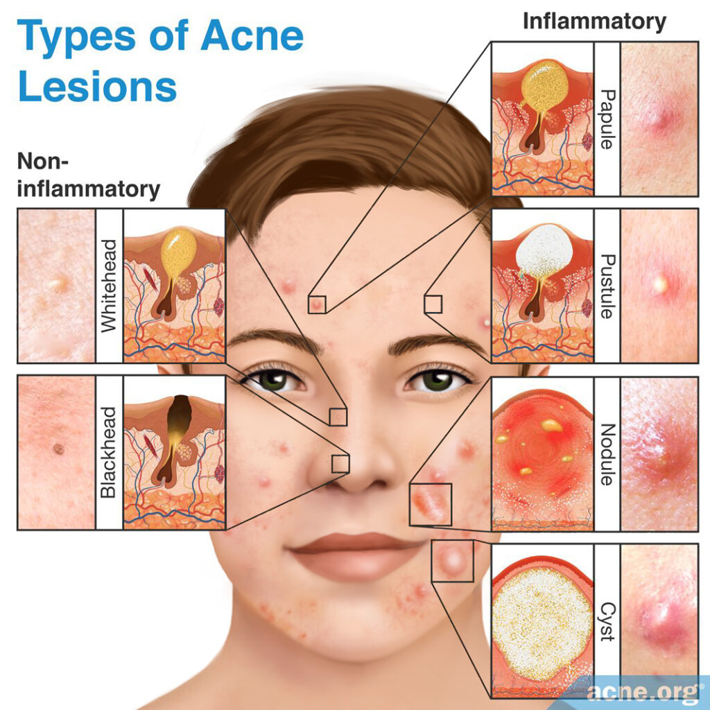 Types of Acne Lesions