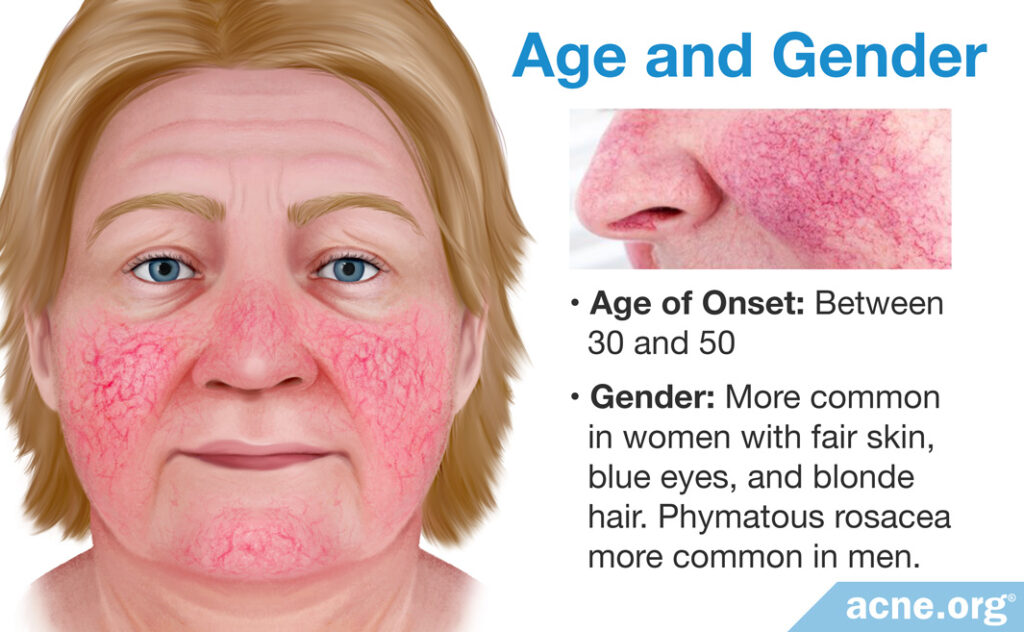 Age and Gender of Rosacea