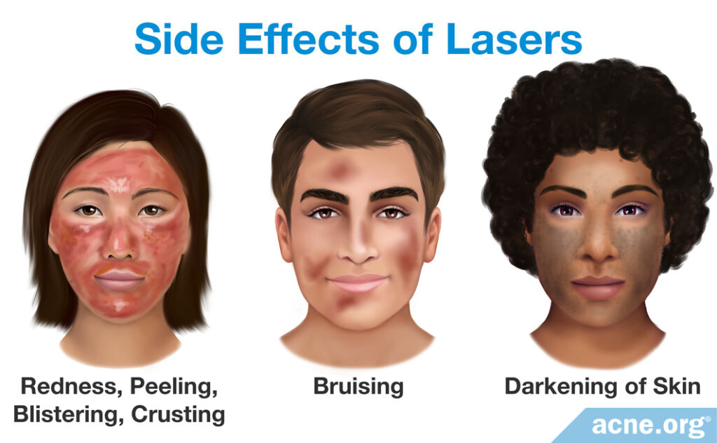 Side Effects of Lasers
