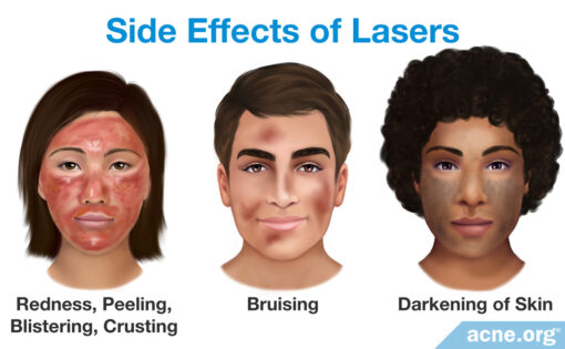 Laser Treatment Side Effects In Tamil