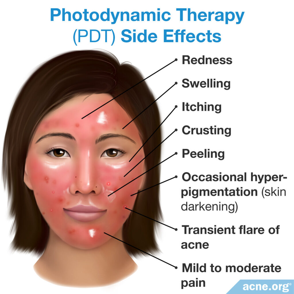 Photodynamic Therapy PDT Acne