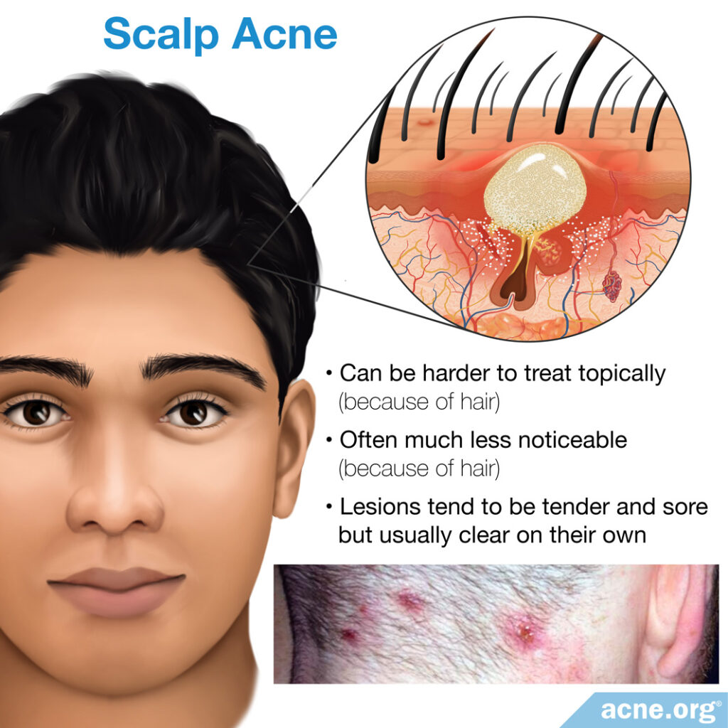 Scalp Acne