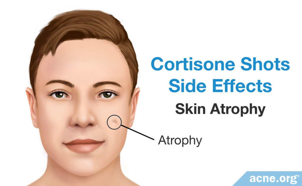 Cortisone Side Effects: Skin Atrophy