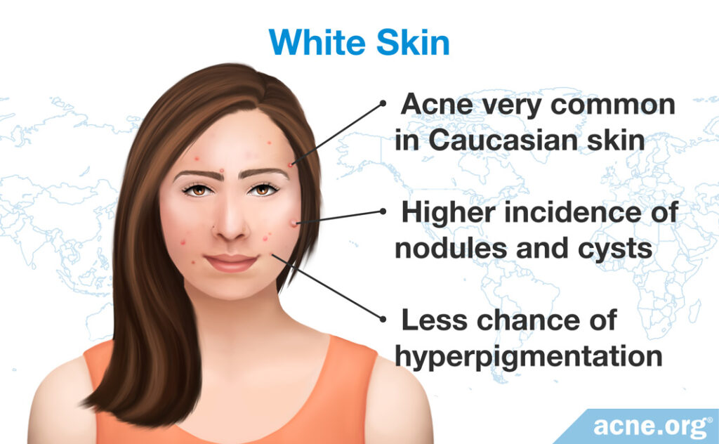 White Skin and Acne