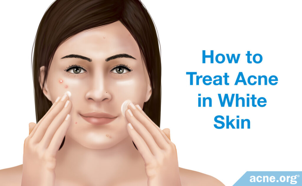 How to Treat Acne in White Skin