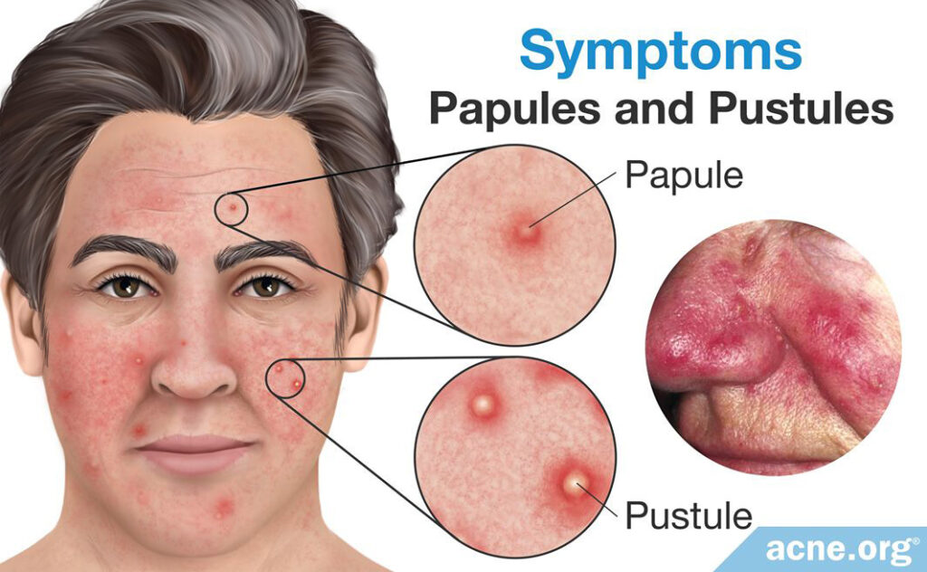 Rosacea Symptoms: Papules and Pustules