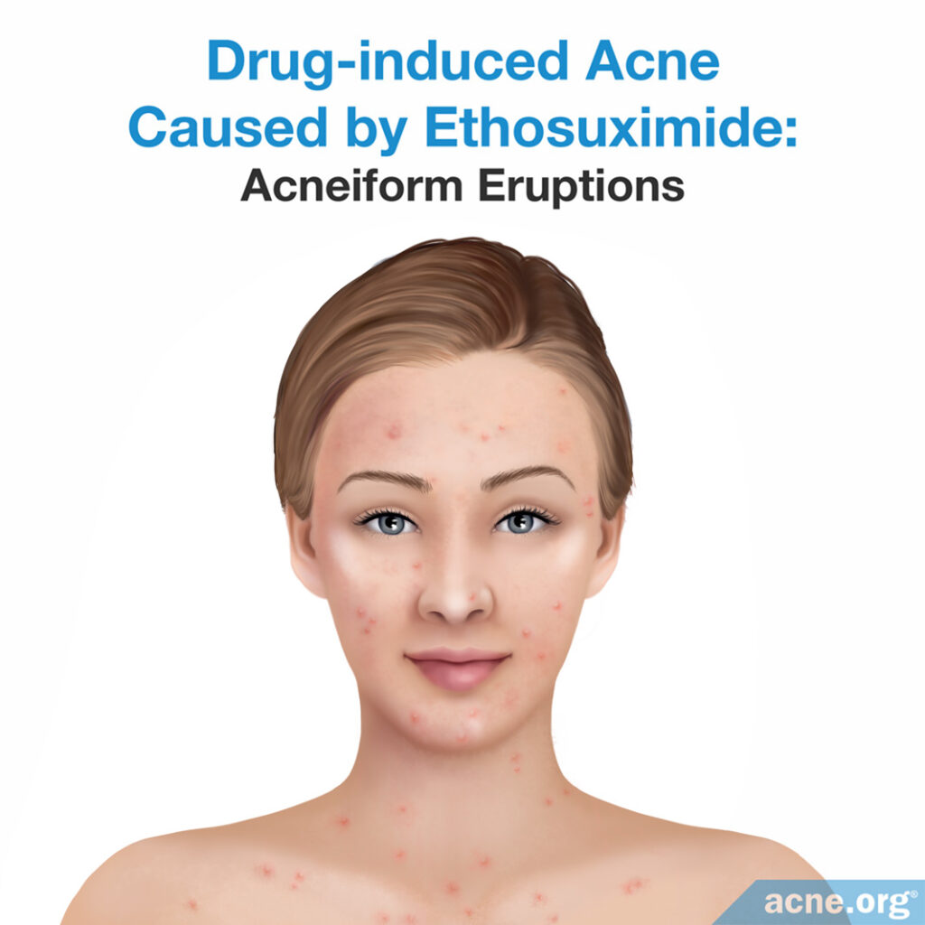 Drug-induced Acne Caused by Ethosuximide