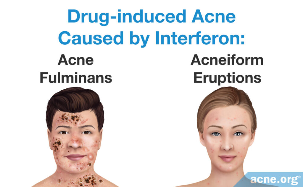 Drug-induced Acne Caused by Interferon