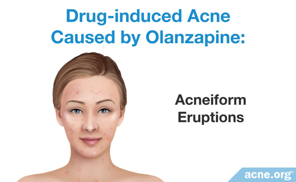 Drug-induced Acne Caused by Olanzapine