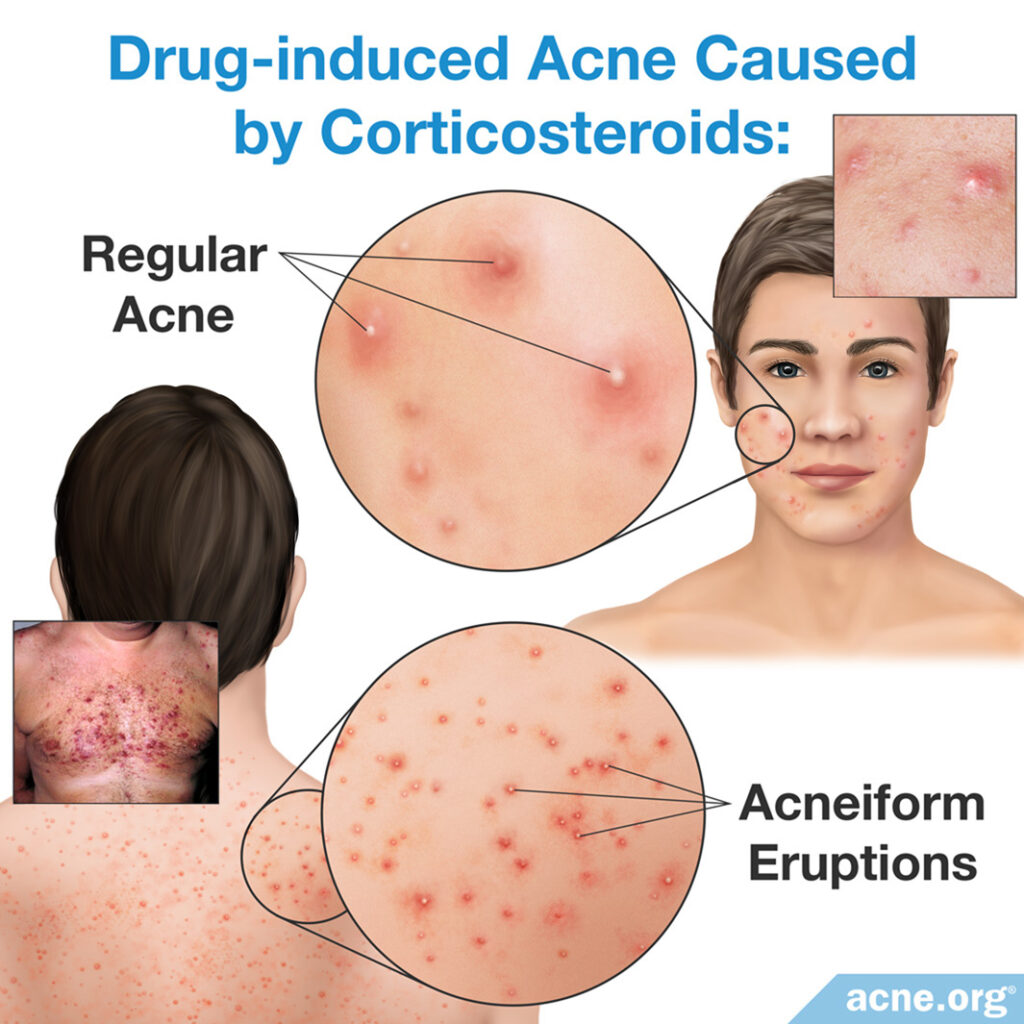 Drug-induced Acne Caused by Corticosteroids