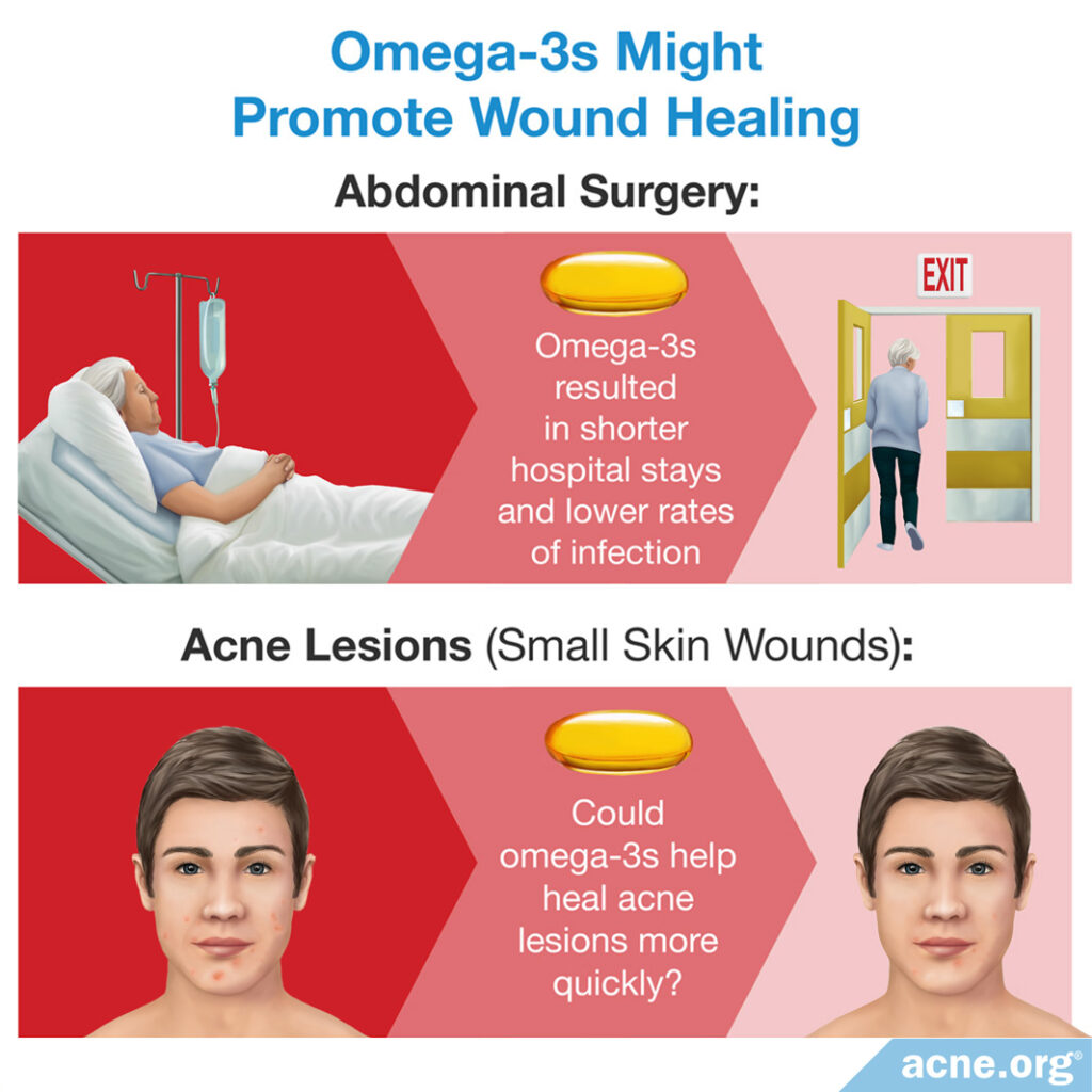 Omega-3s Might Promote Wound Healing