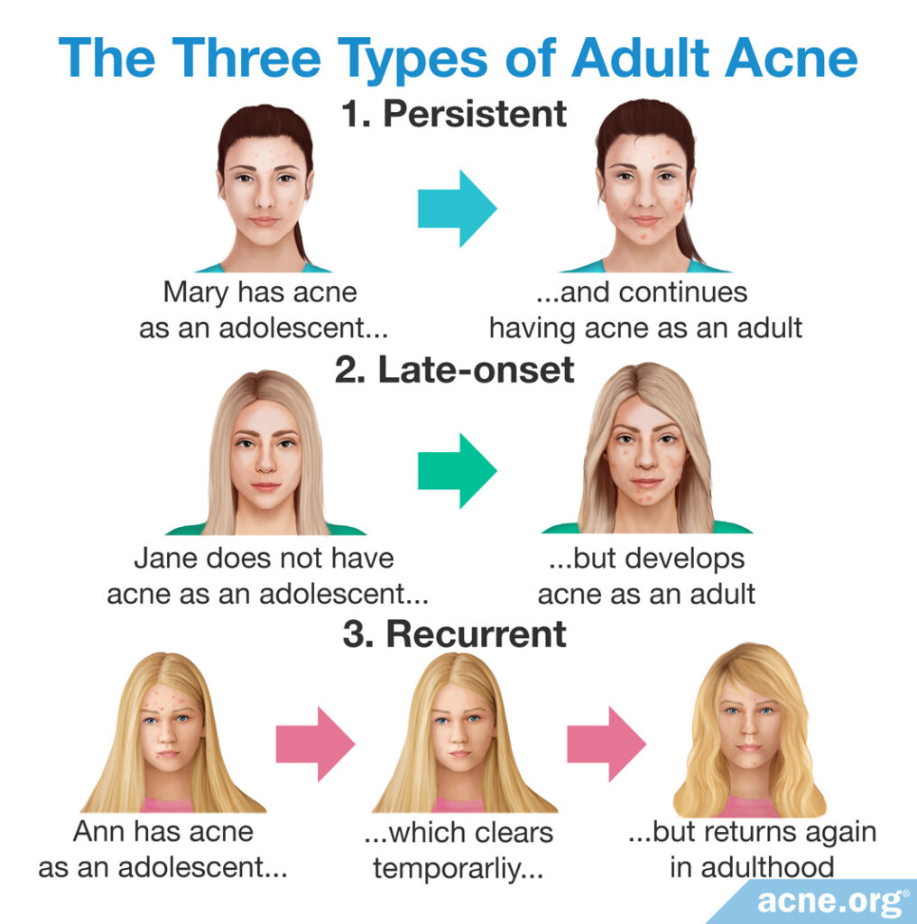 The Three Types of Adult Acne
