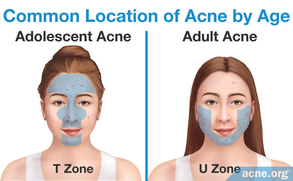 Common location of acne by age