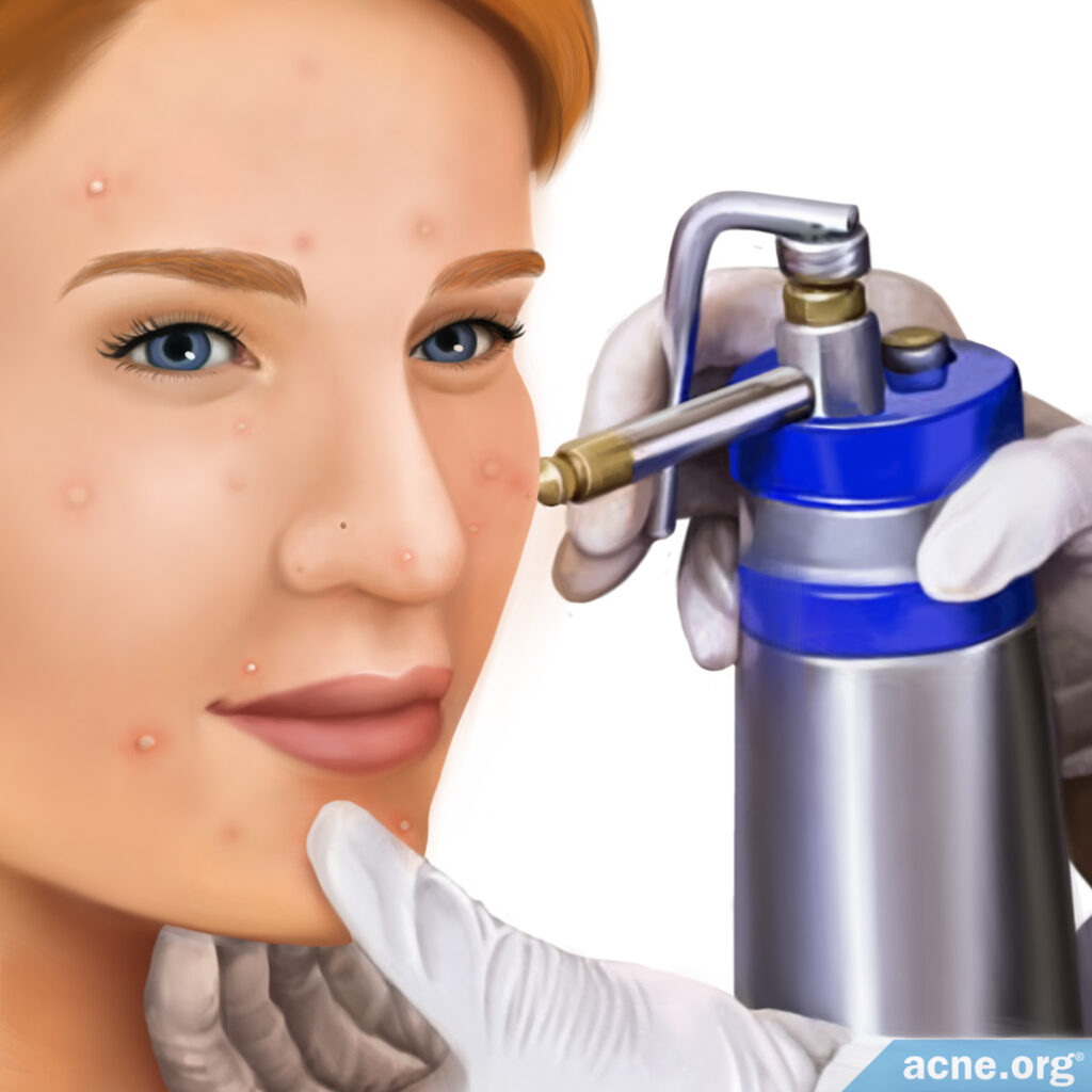 Woman Receiving Cryotherapy Treatment for Acne