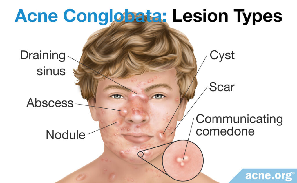 Acne Conglobata Lesion Types