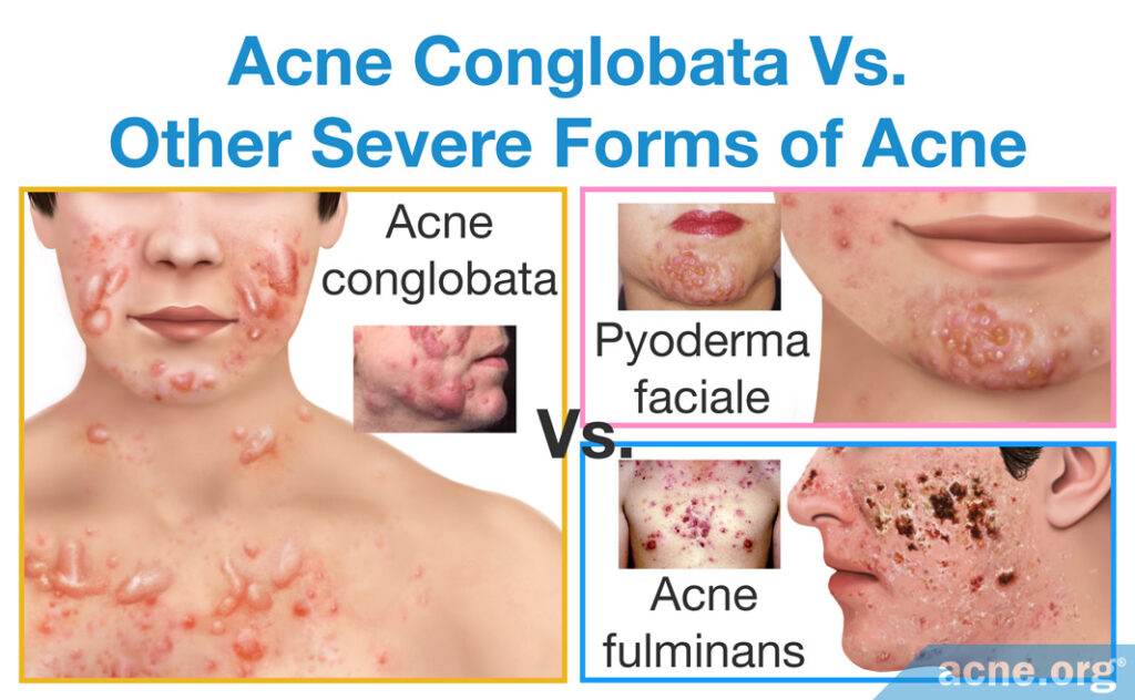 Acne Conglobata Vs. Other Severe Forms of Acne