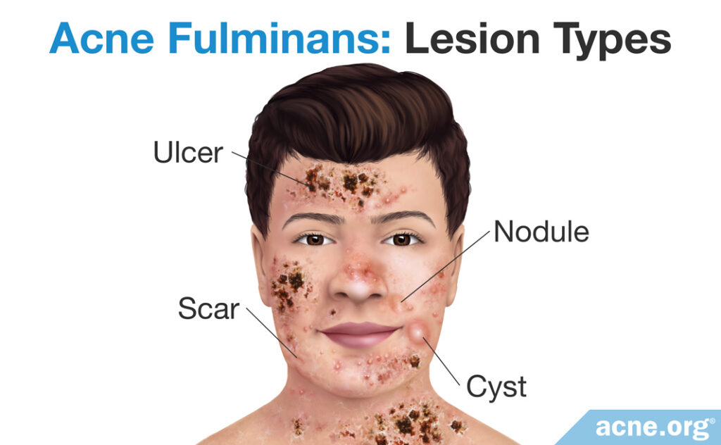 Acne Fulminans Lesion Types