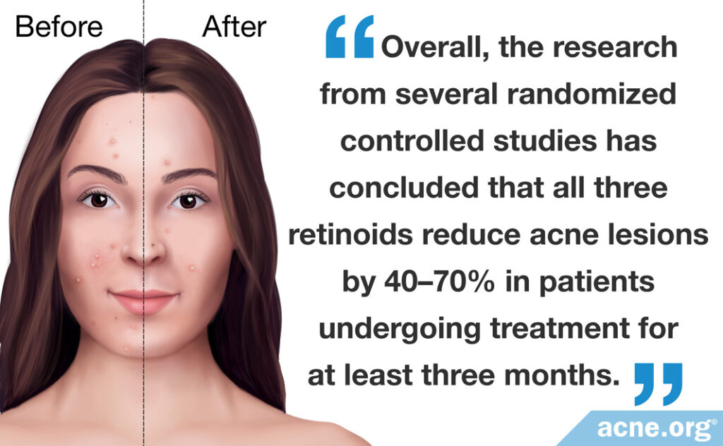 Overall, the research from several randomized controlled studies has concluded that all three retinoids reduce acne lesions by 40-70% in patients undergoing treatment for at least three months