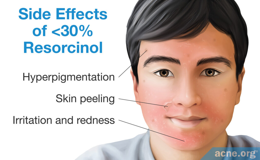 Side Effects of <30% Resorcinol