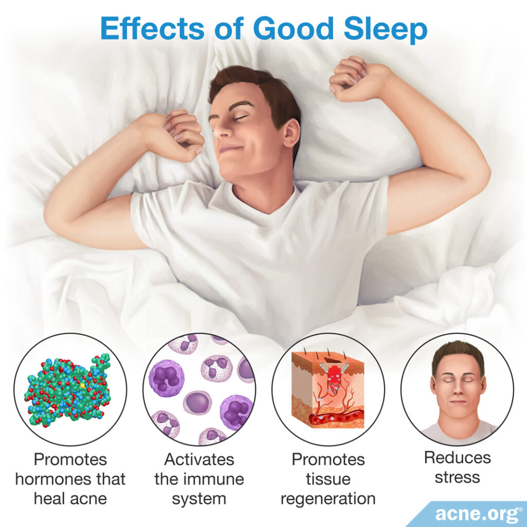 Effects of Good Sleep on Acne