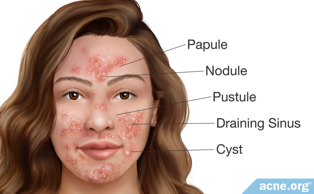 Pyoderma Faciale Types of Lesions