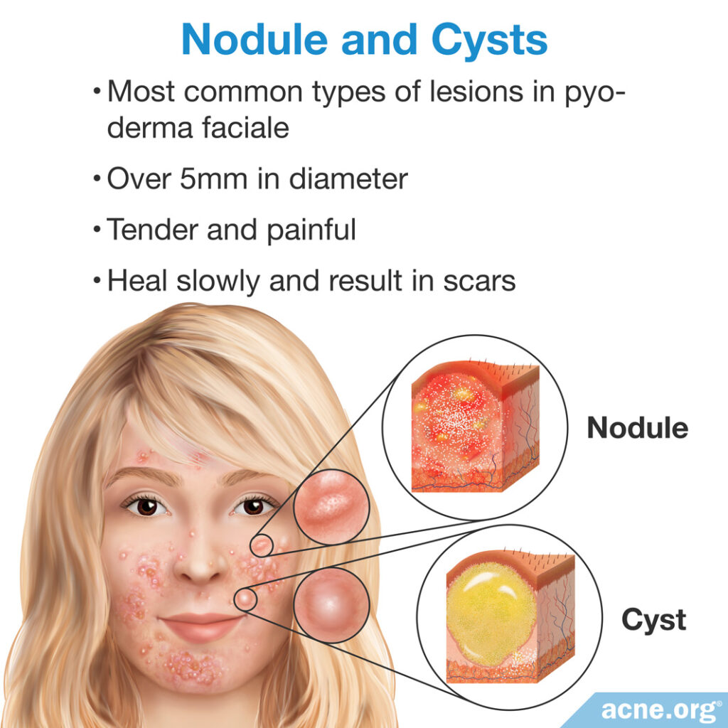 Nodule and Cysts
