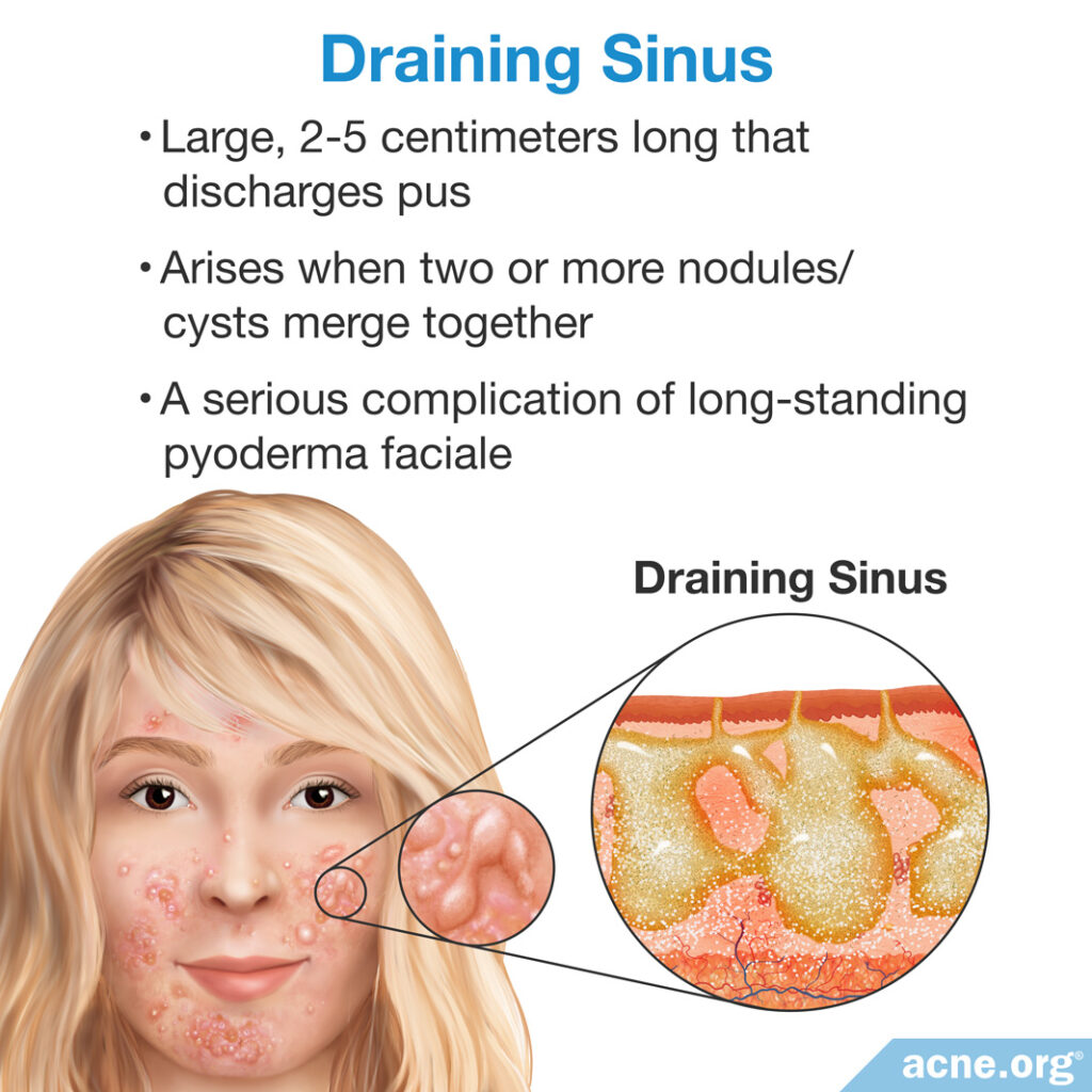 Draining Sinus