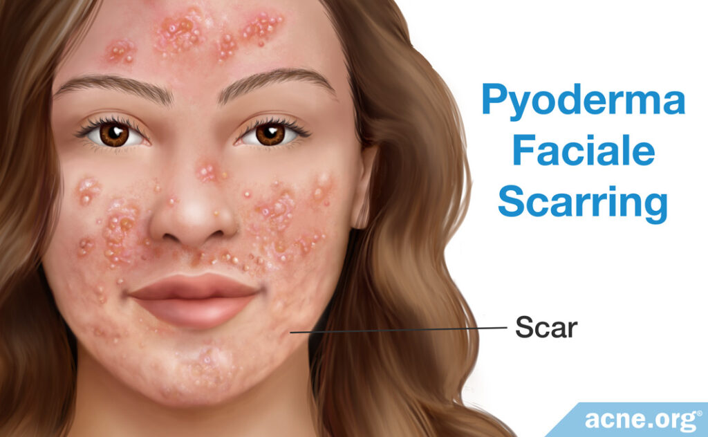Pyoderma Faciale Scarring