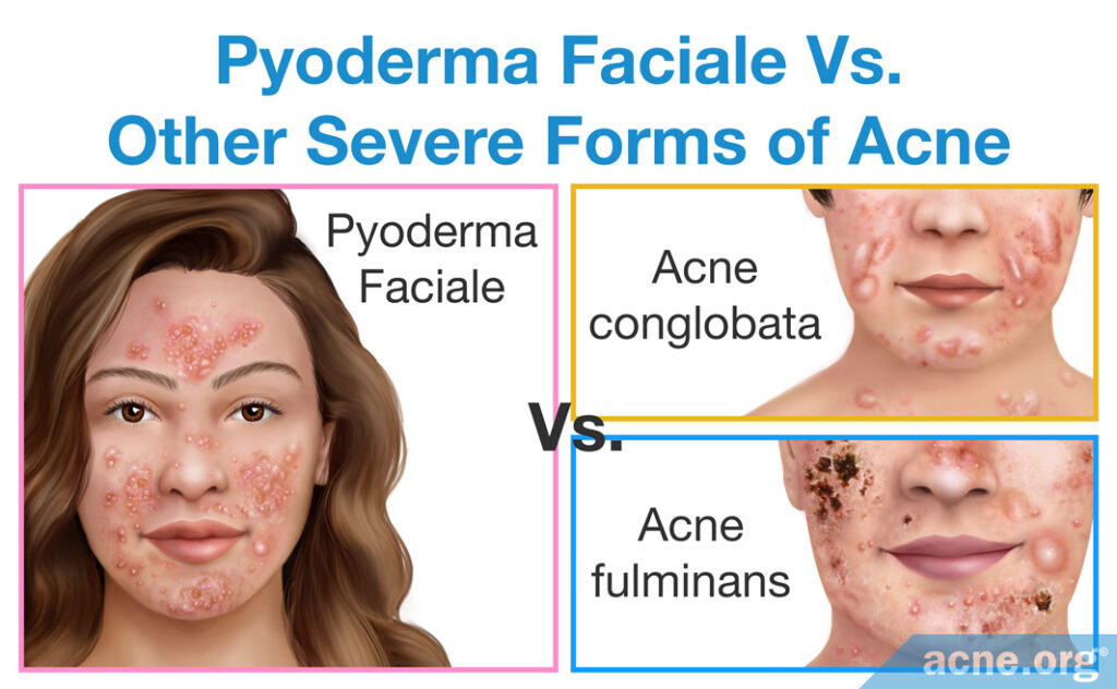 Pyoderma Faciale Vs. Other Severe Form of Acne