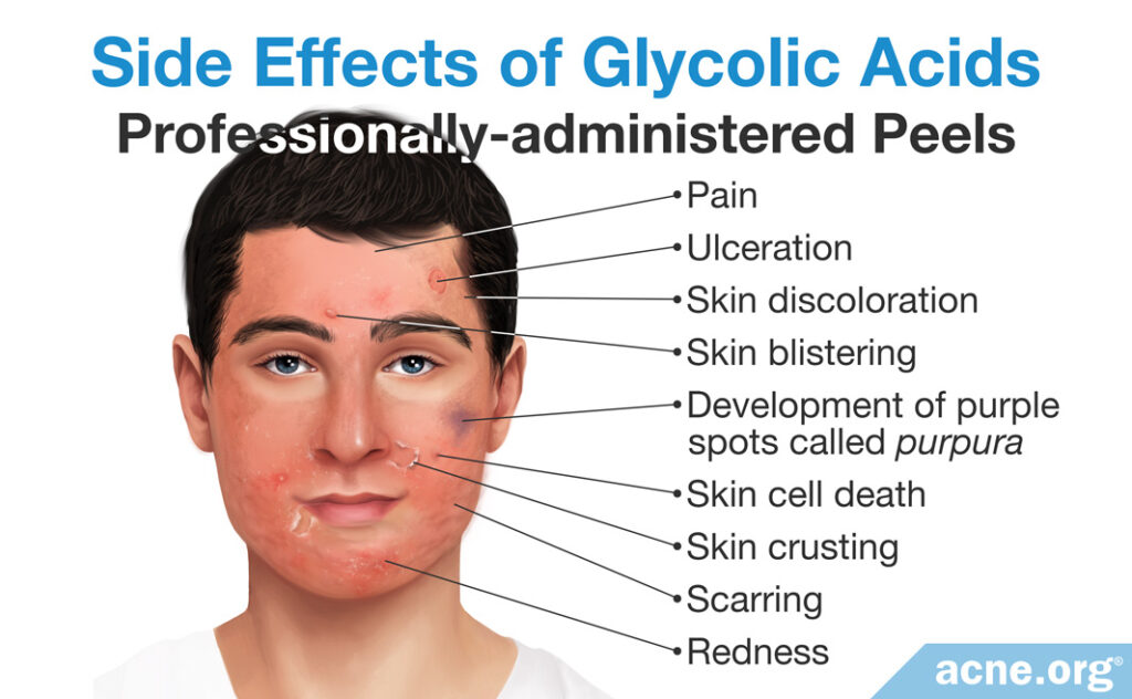 Side Effects of Glycolic Acids