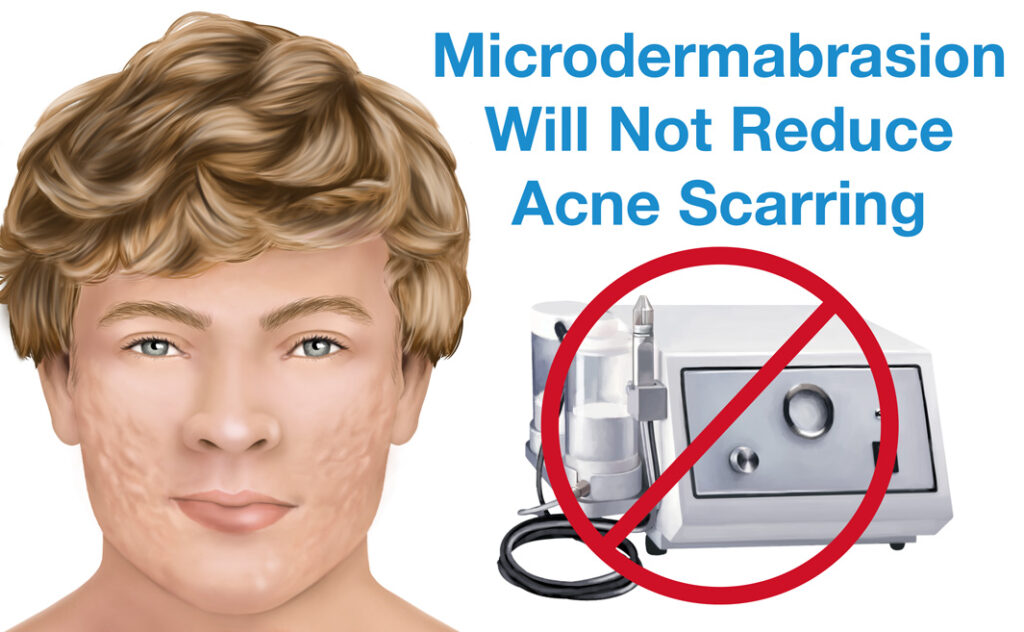 Microdermabrasion Will Not Reduce Acne Scarring