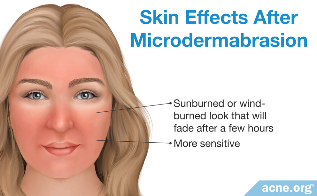 Skin Effects After Microdermabrasion