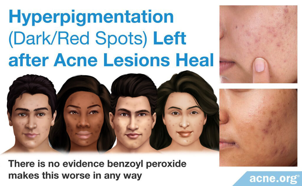 Hyperpigmentation (Dark Red Spots) Left Behind after Acne Lesions Heal