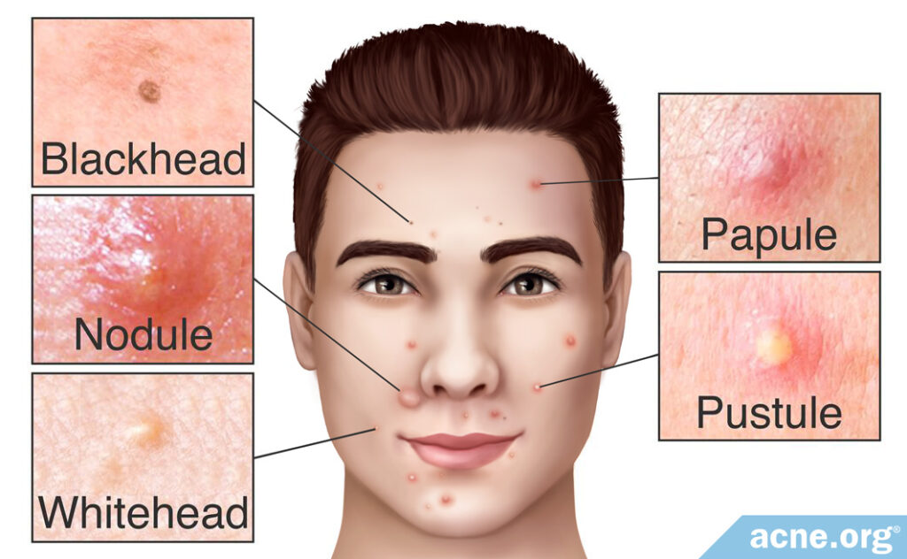 Blackhead Whitehead Nodule Papule Pustule