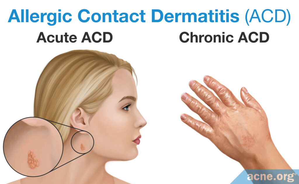 Allergic Contact Dermatitis (ACD) Acute ACD and Chronic ACD