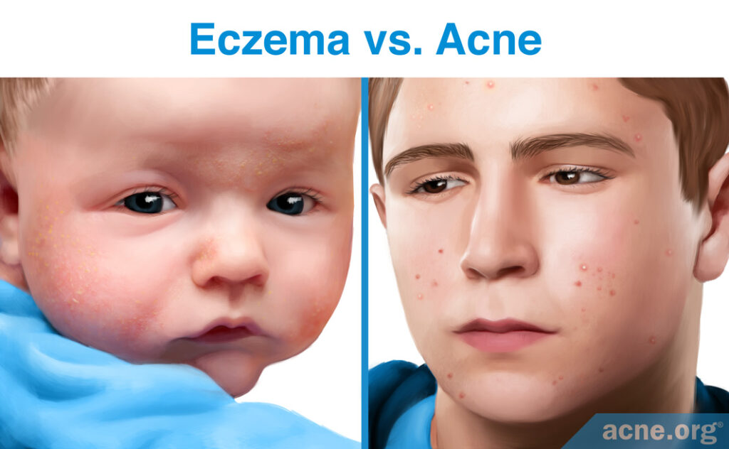 Eczema vs. Acne