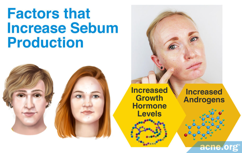 Factors that Increase Sebum Production