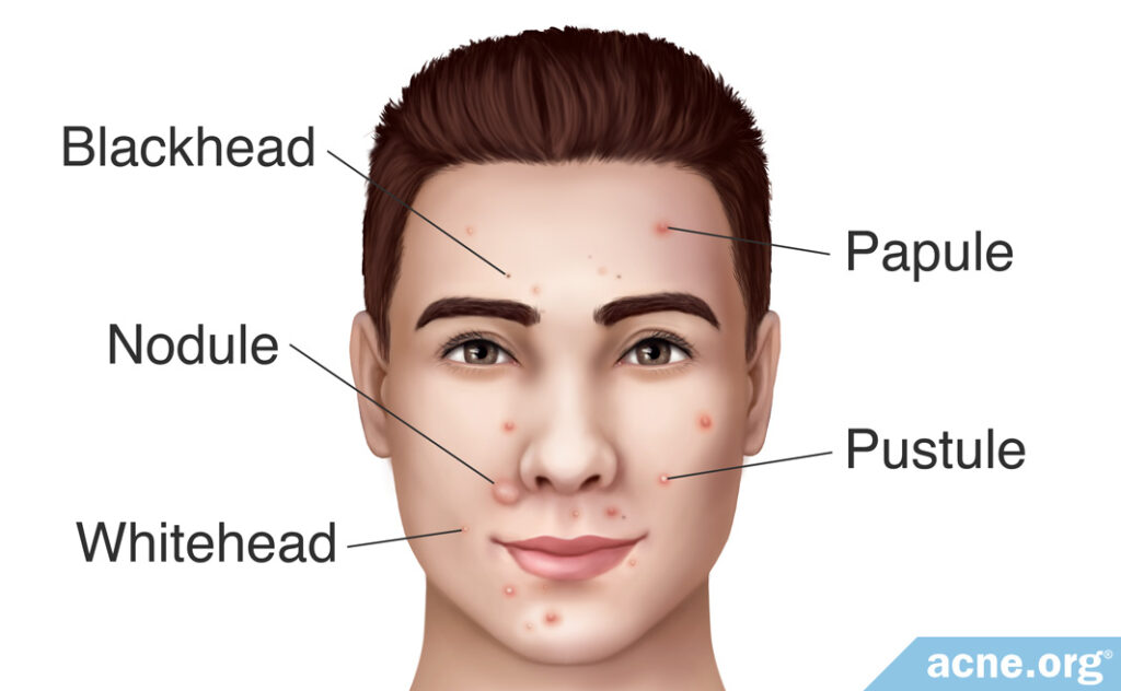 Types of Acne Lesions