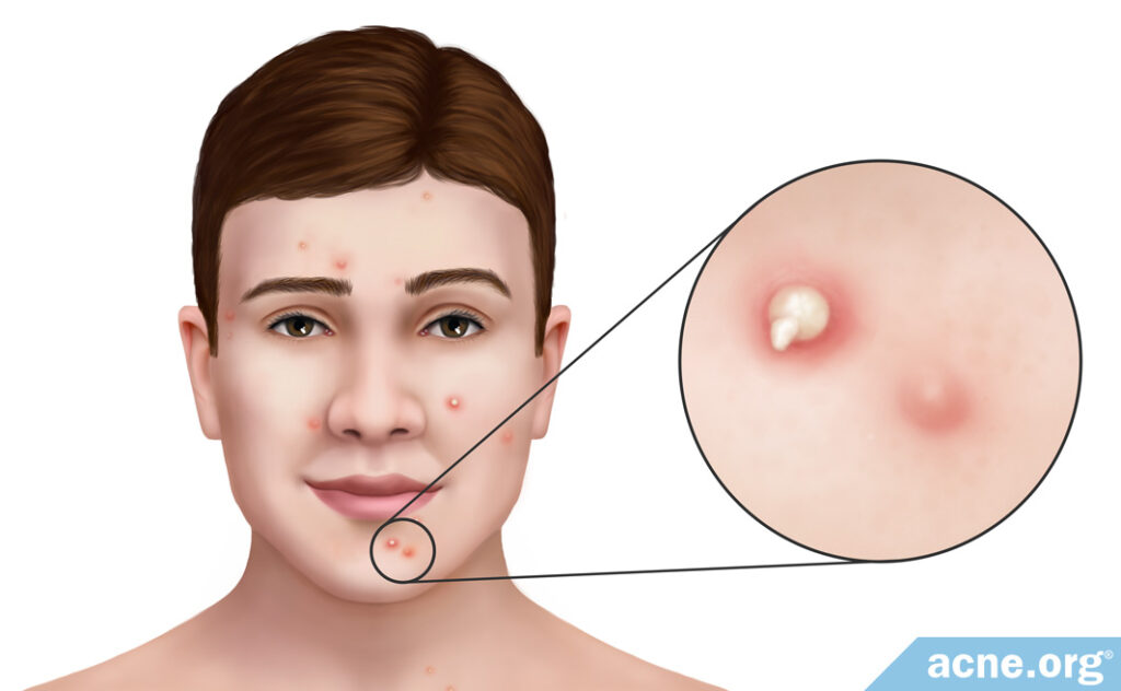 Acne Pustule