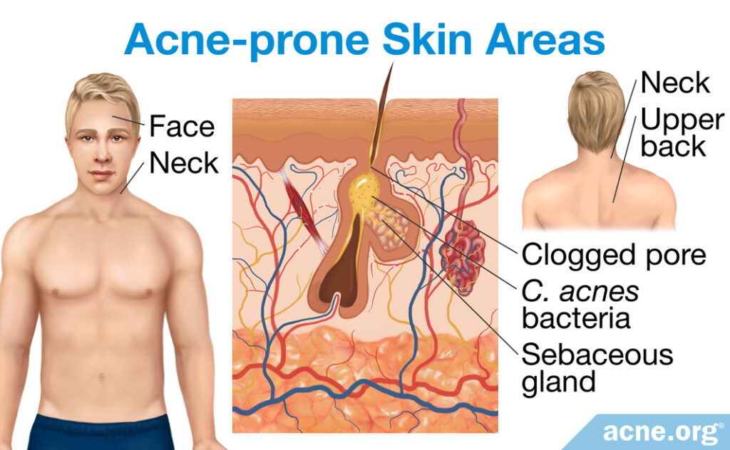 Acne-prone Skin Areas